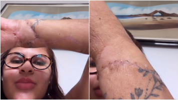 Mulher que teve mãos amputadas pelo ex mostra cicatrizes pela 1ª vez após reimplante: 'marcas do meu milagre'